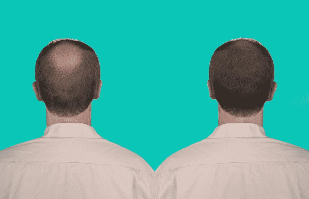 Difference Between the Mature Hairline and Receding Hairline