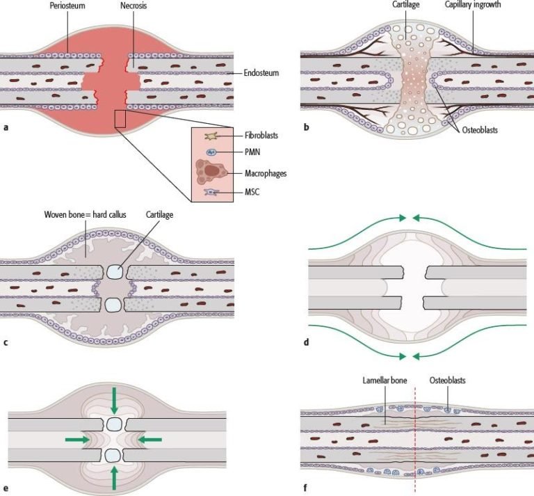 Biology and Biomechanics in Fracture Management