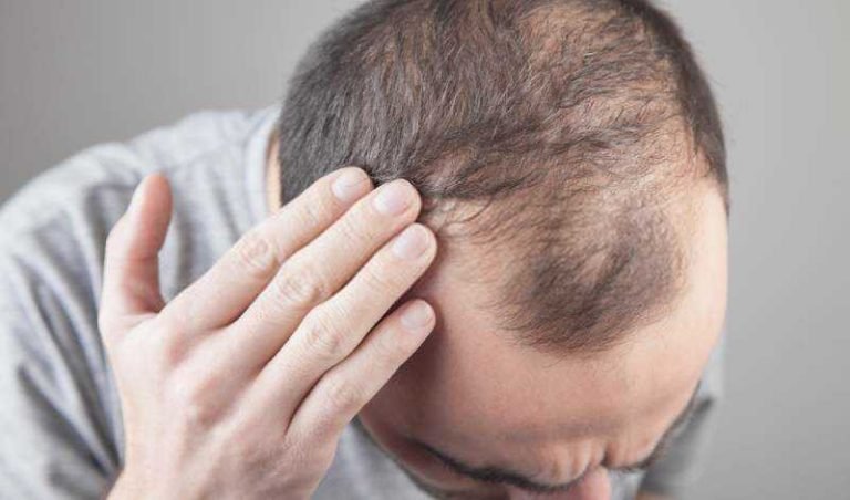 Unveiling The Causes Of Hair Loss In Men