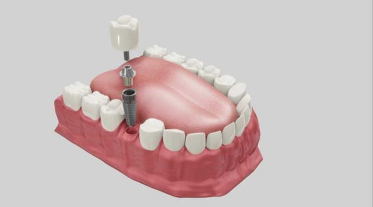 Cheaper-alternative-to-dental-implants
