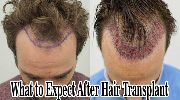 What to Expect After Hair Transplant