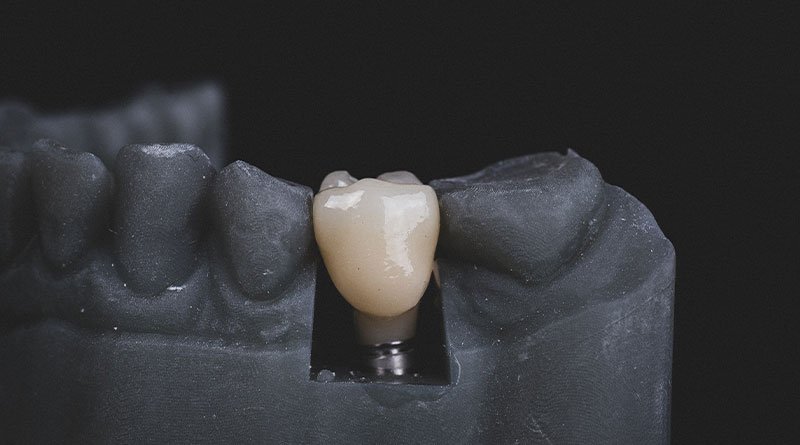 General Dental Implant Techniques