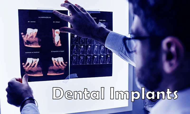 Dental Implants