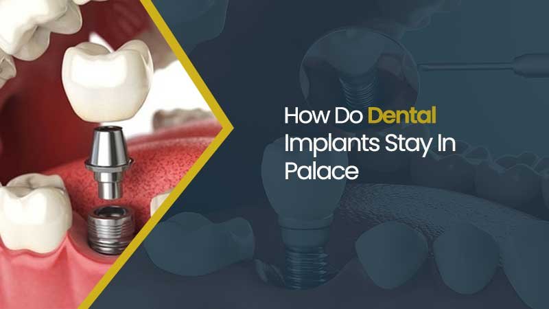 dental implants stay in place